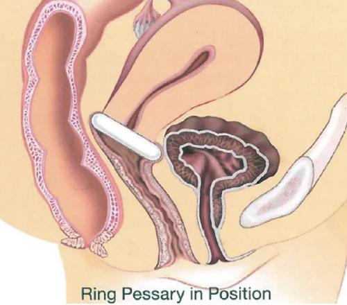 GYN&RING, prstencový pesar bez opory, velikost T4=70 mm, 1 ks